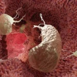 6 simptoma të kancerit të zorrës së trashë që shumë njerëz i injorojnë lehtësisht