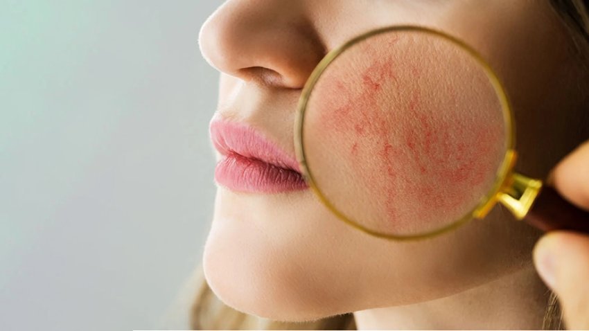 Dy mënyra si të përballeni me kapilarët e pëlcitur: Recetë e konfirmuar shtëpiake!