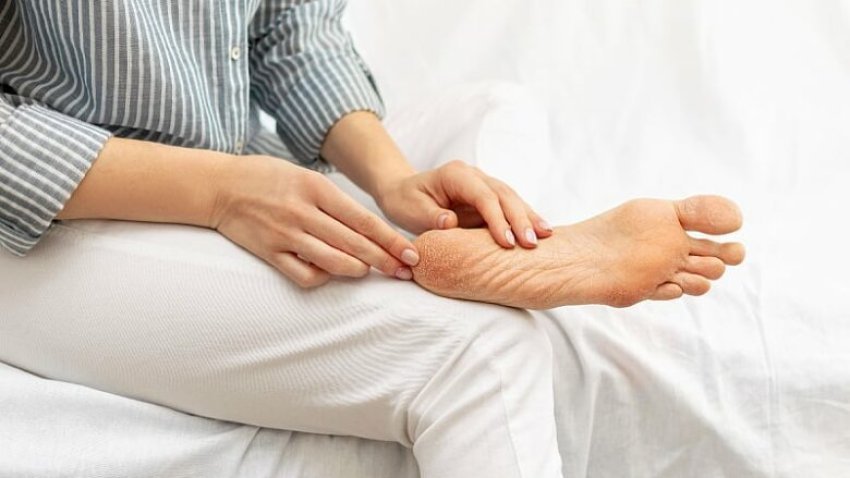 Si të shpëtojmë nga thembrat e çara, këshilla për këmbë të lëmuara dhe të kuruara