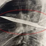 Si një burrë jetoi për 8 vjet me një thikë në gjoksin e tij?