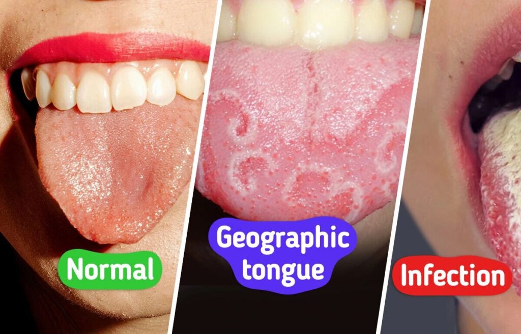 Gjuha ‘harta’ e organizmit tonë! Ngjyra dhe forma e saj paralajmëron sëmundje, nga mëlçia tek zemra e stomaku…