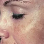 Njollat kafe në fytyrë, problemi vjen nga brenda organizmit?