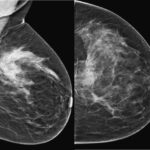 Kanceri i gjirit nuk po “fal” as vajzat e reja nën moshën 30 vjeç! / Mjekja ka një këshillë për të gjitha gratë dhe vajzat