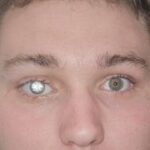 Si në filmat e James Bond-it: Biznesmeni vendos diamant 2-karatësh në syrin artificial