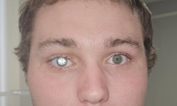 Si në filmat e James Bond-it: Biznesmeni vendos diamant 2-karatësh në syrin artificial