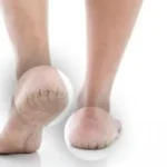 Zgjidhje të thjeshta nga shtëpia për thembra të çara