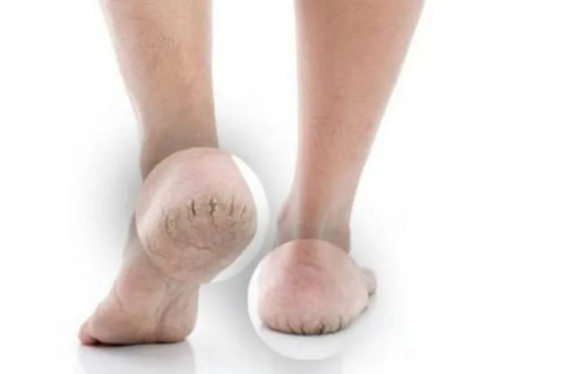 Zgjidhje të thjeshta nga shtëpia për thembra të çara