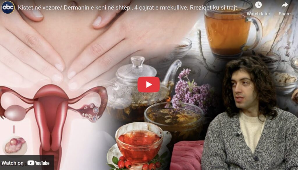 Kistet dhe shëndeti i vezoreve/ Mjeku alternativ tregon shkaqet e shfaqjes së tyre: Ja ushqimet që duhet të konsumoni